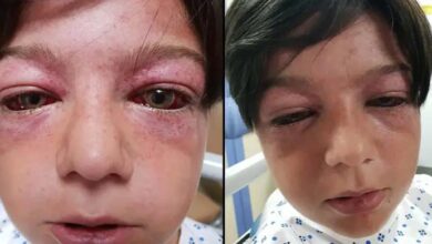 Photo of Playground craze leaves 11-year-old boy “looking like an alien” – mom issues warning for parents