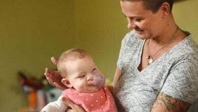 Photo of The incredible story of Sloan McGillis: She was born with a giant facial tumor – but overcame all obstacles