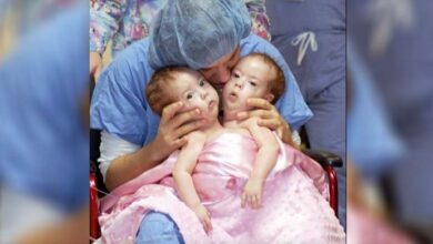 Photo of 10 years ago these conjoined twins were separated through advanced surgery: Now they are all grown up