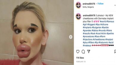 Photo of 25-Year-Old Bulgarian Woman Does More Than 27 Procedures To Have The Biggest Lips In The World