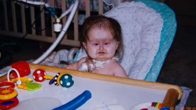 Photo of Baby Born With Unusual Syndrome – 22 Years Later She Looks Amazing