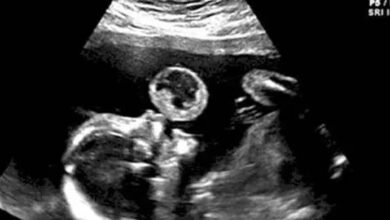 Photo of Mom Thinks Her Baby Is Blowing Bubble In Ultrasound, Then Doctors Discover What It Really Is