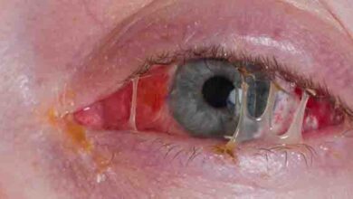 Photo of How to Avoid an Eye Infection: Eye Health Essentials