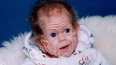 Photo of Baby Born With Enough Skin For A 5-Year-Old, Try Not To Shed A Tear When You See Him Now