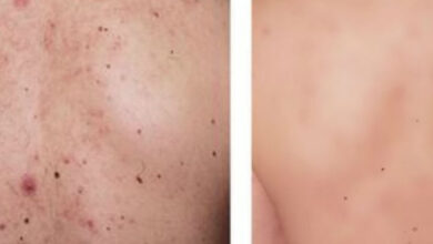 Photo of 10 Ways to Get Rid of Body Acne