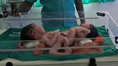 Photo of The Inspiring Journey of Twins Connecting Their Bodies Together