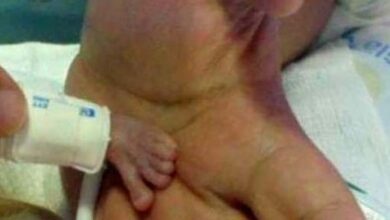 Photo of One of the smallest babies in the world was born!