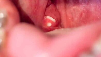 Photo of Tonsil Stones: Small But Fascinating