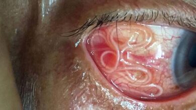 Photo of ST3. Doctor Shudders as 15cm Long Worm is Removed from Patient’s Eye