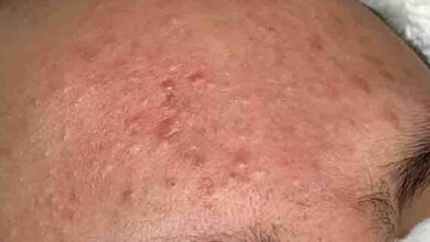 Photo of SKIN blackhead treatment