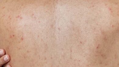 Photo of 10 Effective Tips for Eliminating Body Acne