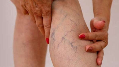 Photo of 7 Exercises to Reduce Spider and Varicose Veins