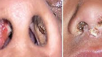 Photo of 4.. Why You Keep Getting Pimples Inside Your Nose, and What to Do About it